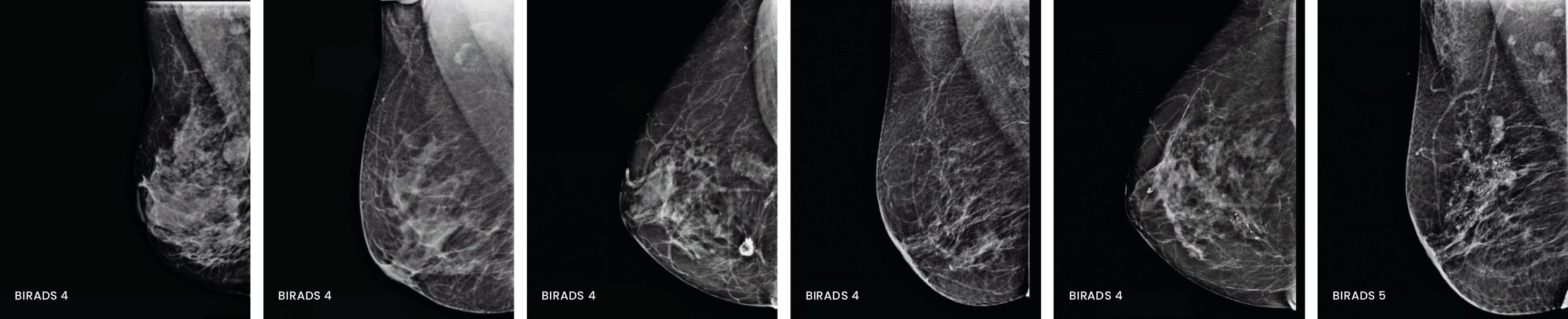 BIRADS